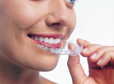 Retainers Platinum Orthodontics
