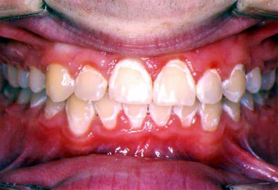 braces hygiene poor oral orthodontics platinum need hard know