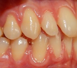 03-01-Right-Buccal