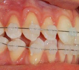 03-02-Right-Buccal