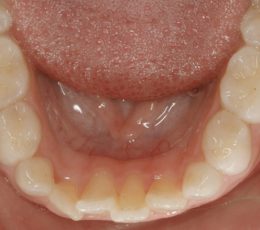 Initial-Lower-Occlusal