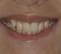 Pre-Treatment-Mouth-Smile