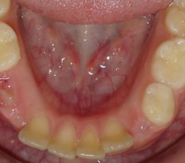 Lower Occlusal Initial