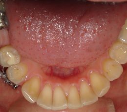 lower occlusal initial
