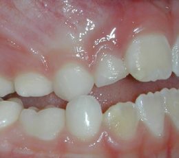 Initial Right Buccal
