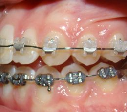 Braces-and-MSI-Left-Buccal