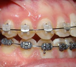 Braces-and-MSI-Right-Buccal