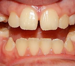 Anterior Teeth