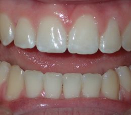 Anterior Teeth