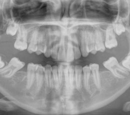 OPG X-ray after first molars removed